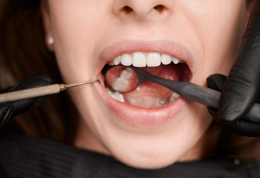 Dental Inlays and Onlays in Anand